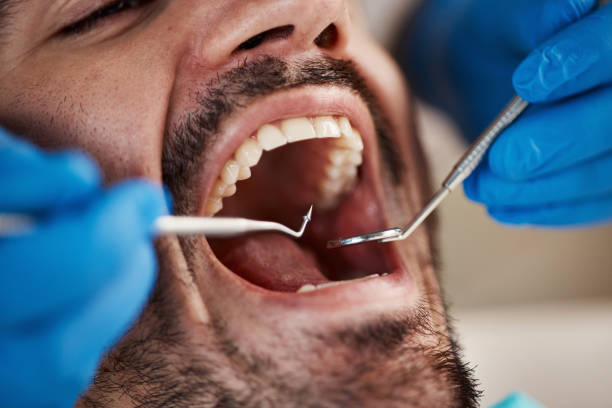Best Emergency Dentist for Lost Fillings or Crowns in Vienna, GA